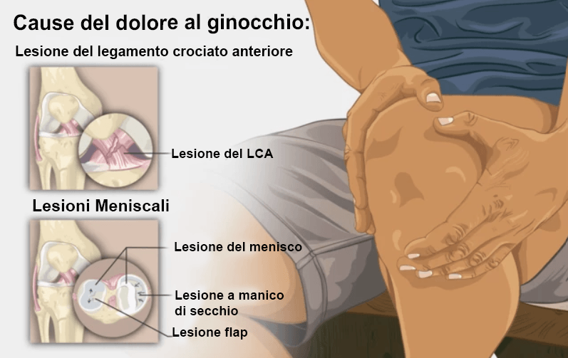 artroscopia di ginocchio